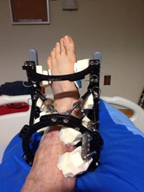 The external fixator... or as we call it - the cage of hell. 