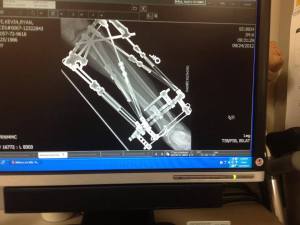 An x-ray of the external fixator. 